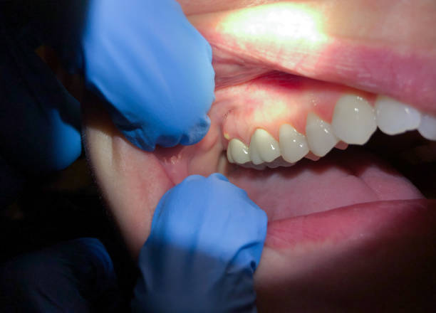Best Emergency Wisdom Teeth Removal in Schofield, WI